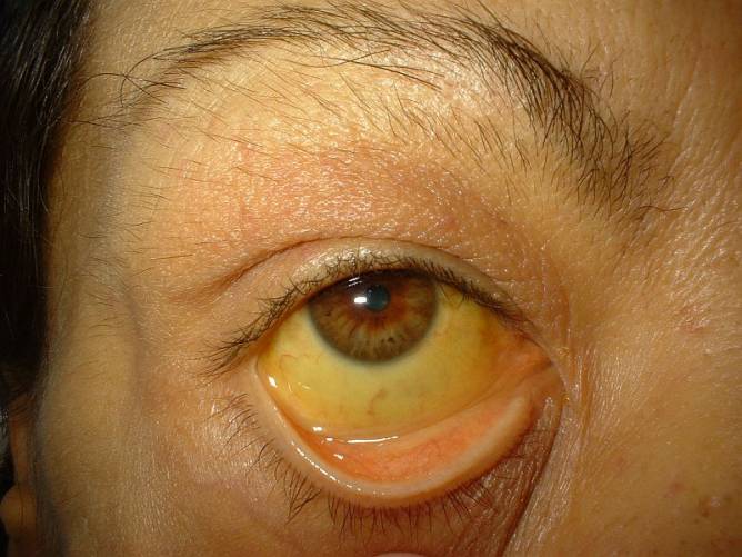 A szem ínhártyájának sárga elszíneződése májbetegségben