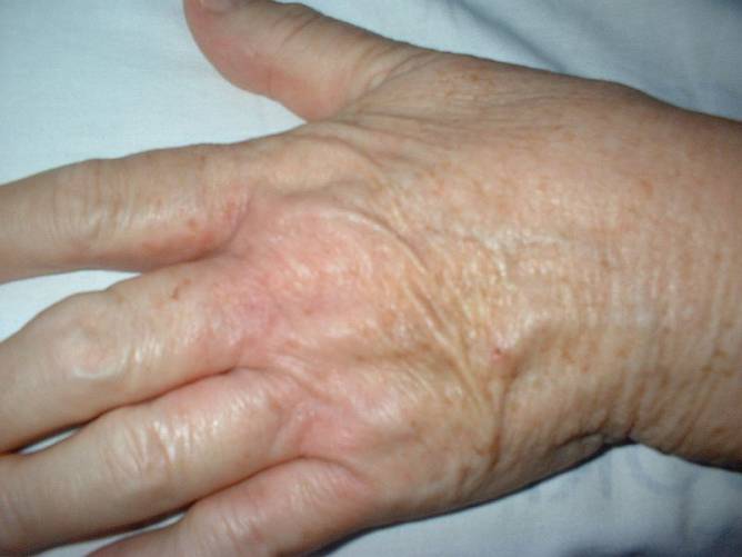 Dermatitisz (bőrgyulladás) a kézen.