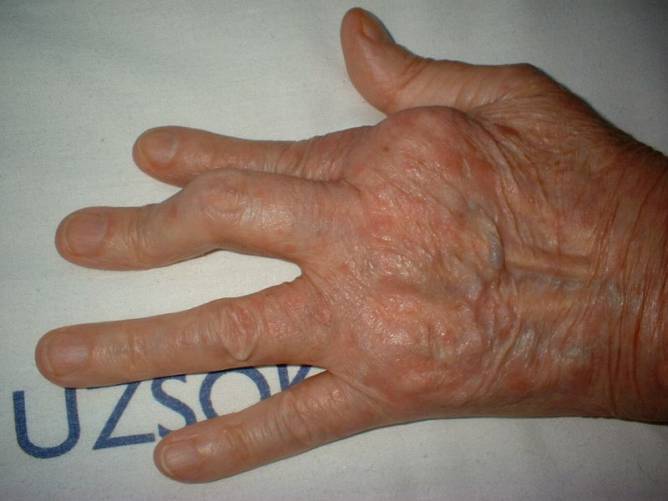 A kéz kisízületeinek deformitása pikkelysömör következtében