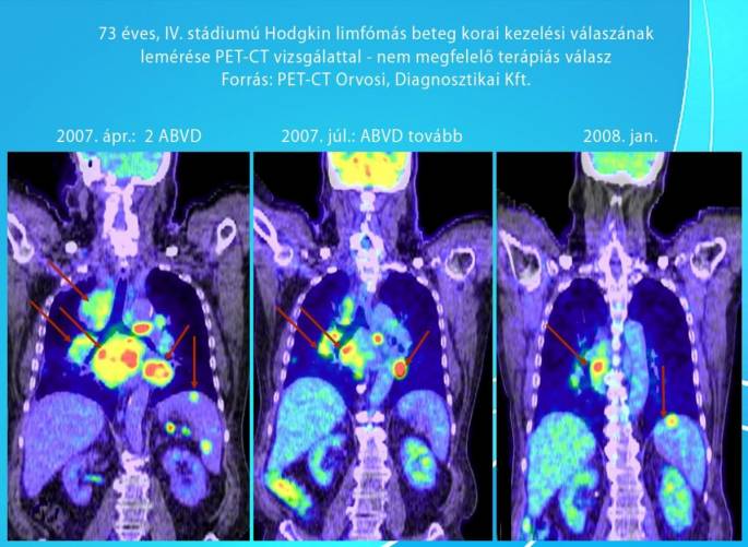 73 éves, IV. stádiumú Hodgkin limfómás beteg korai kezelési válaszának lemérése PET-CT vizsgálattal. Nem megfelelő terápiás válasz.