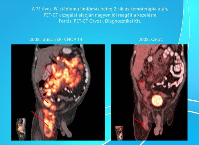 A 71 éves, IV. stádiumú limfómás beteg két ciklus kemoterápia után. PET-CT vizsgálat alapján nagyon jól reagált a kezelésre.