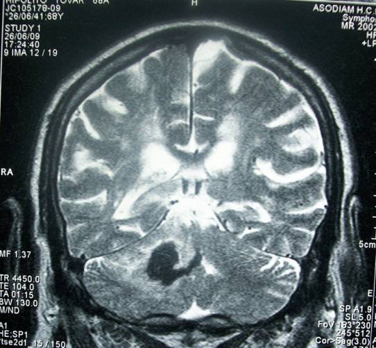Stroke - Agyvérzés CT-felvételen