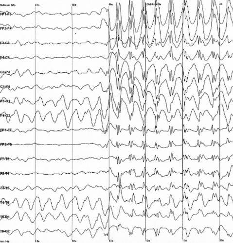 Epilepszia EEG-görbe