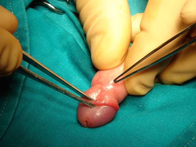 Fitymaszükület műtét