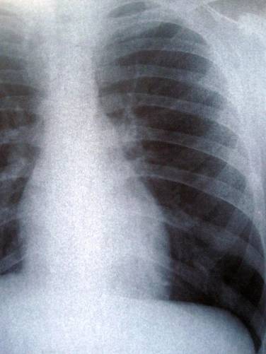 Bal mellkasfélre fókuszáló röntgenkép