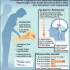 Infografika a Parkinson-kórról