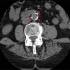 CT-felvétel meszes hasi aortáról