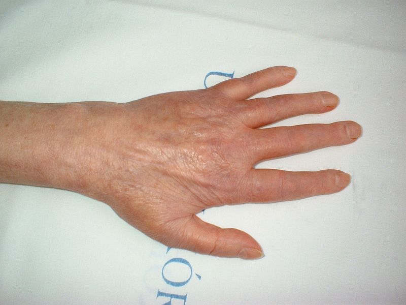 a láb rheumatoid arthritise