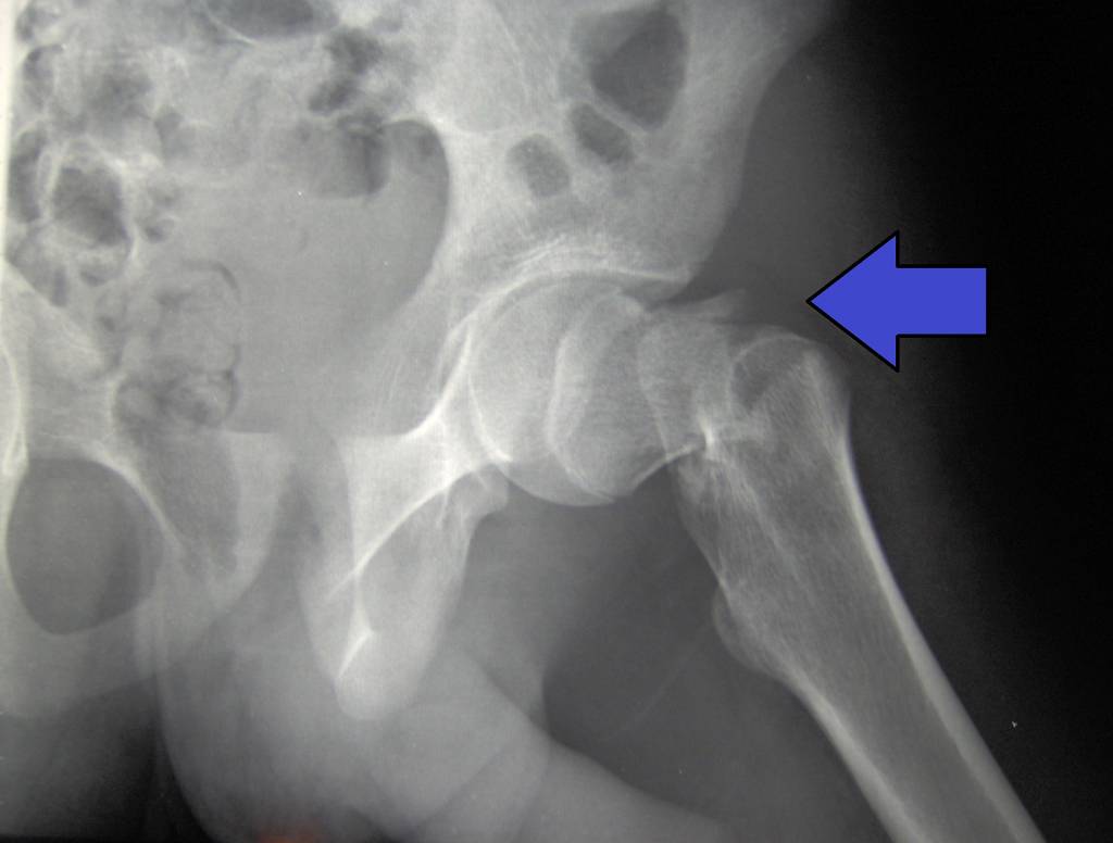 zárt törés rheumatoid arthritis ízületi röntgenképe