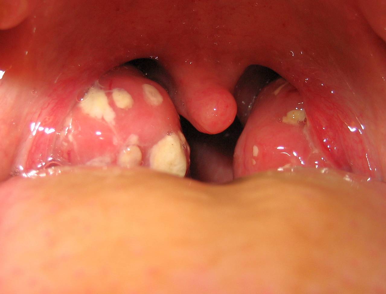 tonsillectomia fogyás felnőttek