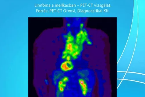 Limfóma a mellkasban (PET-CT)
