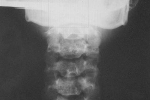 Nyaki borda röntgenfelvételen