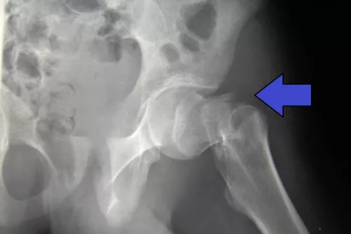 Csípőízületi röntgenfelvétel, combnyaktörés