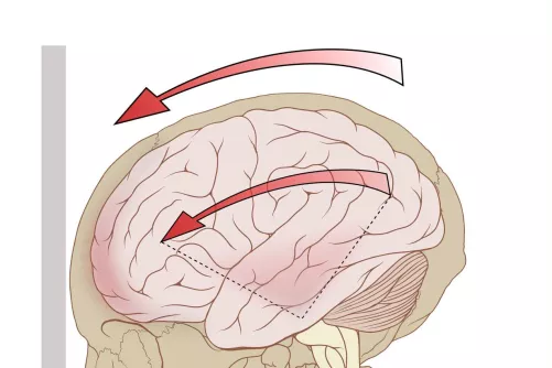 Az agyrázkódás sematikus illusztrációja