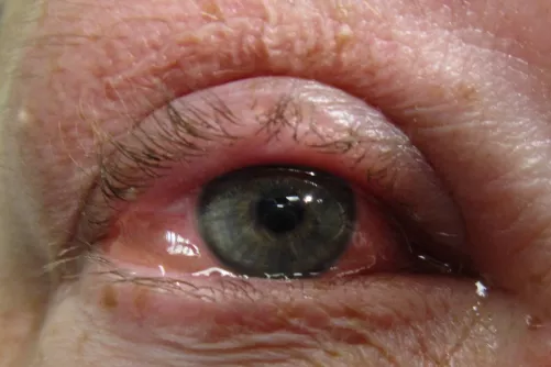 Allergiás kötőhártyagyulladás