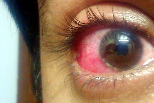 Kötöhártyagyulladás, belövellt szem