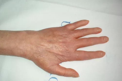 Rheumatoid arthritis kézen