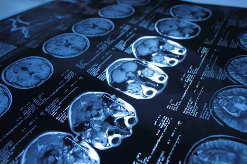 CT felvétel, csak koponya