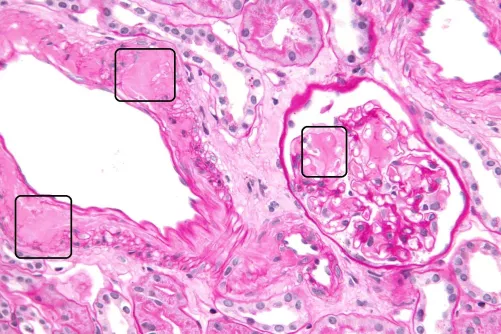 Amyloid lerakódás vesében (szövettani kép)