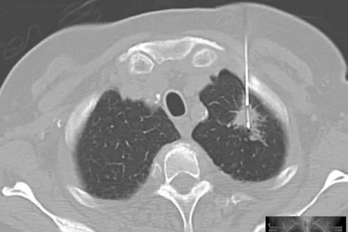 Gyanús szövetszaporulat biposziája tüdőben.