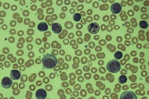 Fehérvérsejtek (limfoblasztok) mikroszkópos képe