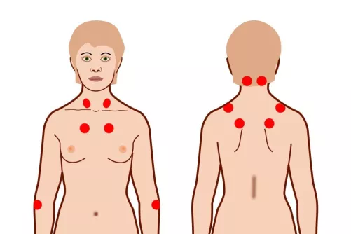 Fájdalmas pontok jelölése.