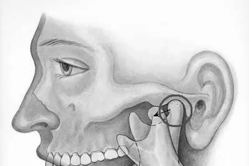 Állkapocsízületi ficam sematikus rajzon