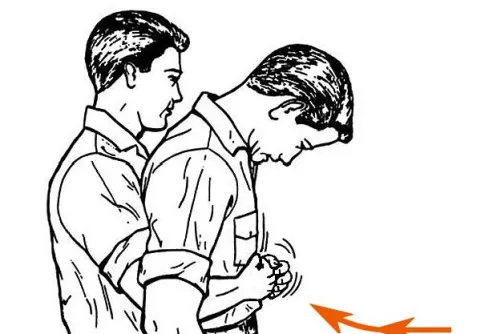 Heimlich-manőver kivitelezése