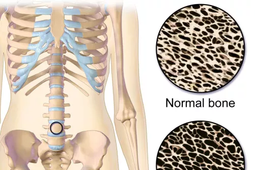 Csontritkulás szöveti kép, tipikus helyek (csigolya, combnyak). 