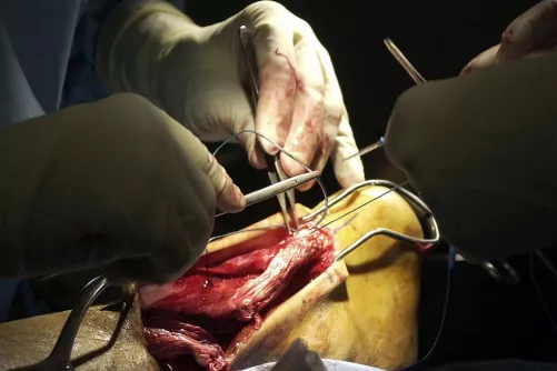 Elszakadt Achilles-ín műtéte