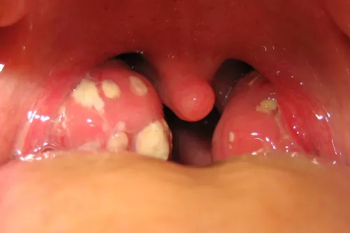 Gyermek gyulladt mandulái tüszőkkel