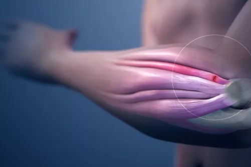 Tendinitis számítógépes illusztráció