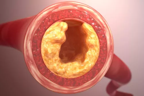 Elzáródó artéria grafikus illusztrációja