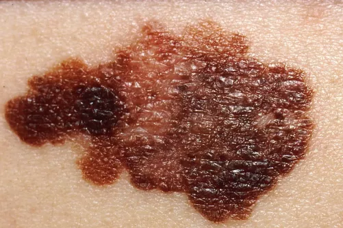 Melanoma malignum