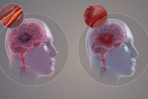 A stroke két formája – grafikus illusztráció