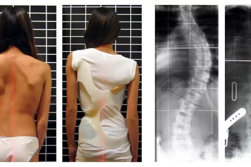 Gerincferdüléses páciens kezelés előtti és utáni képei