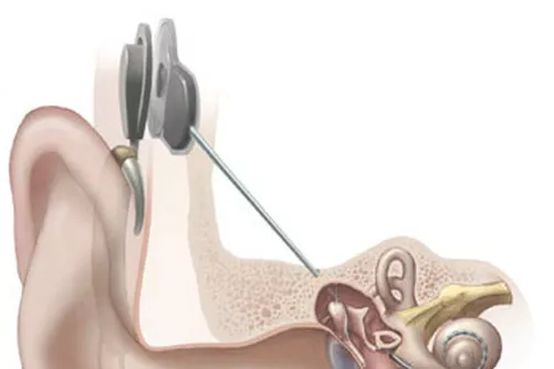Cochleáris implantátum sematikus ábrán