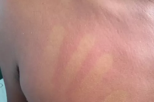 Dengue-láz bőrvörösödés