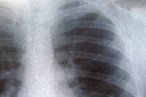 Bal mellkasfélre fókuszáló röntgenkép