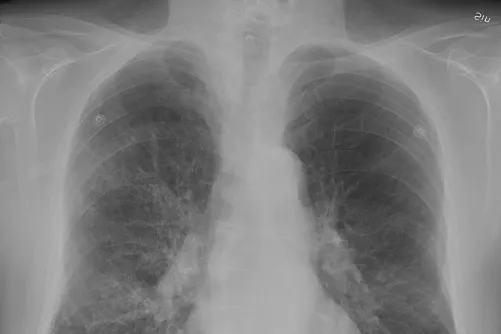 COPD-beteg mellkasi röntgenfelvétele