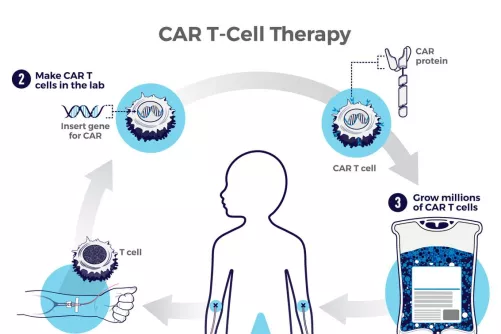 Display a CAR T-sejtes kezelésről