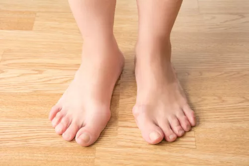 Hallux valgus, azaz "bütyök"