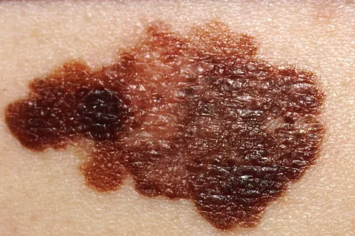 Melanoma malignum inhomogén foltja