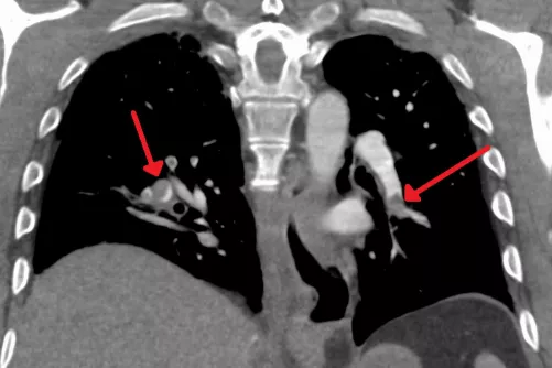 Embólia tüdőben rétegfelvételen