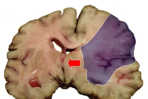 Agyi metszet boncolásból