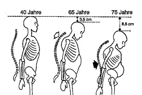 Magasság csökkenése csontritkulásban 65-75 éves korra 