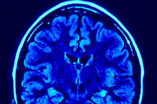 Az agy frontalis metszete képalkotó eszközzel