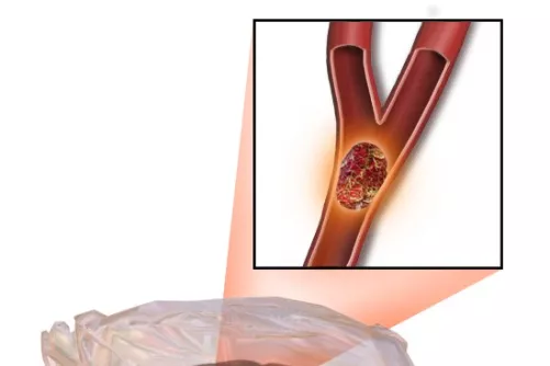 Stroke, agyi érelzáródás sematikusan
