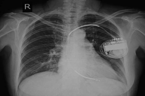 Pacemaker röntgenfelvételen