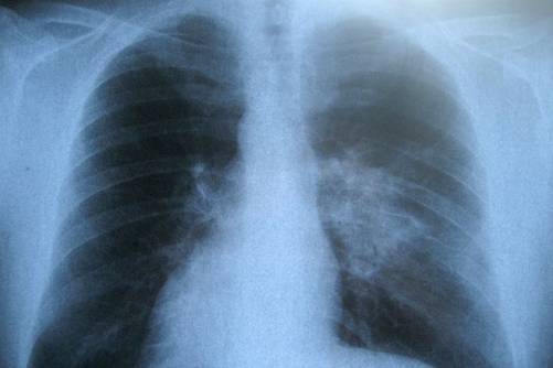 Tüdő (röntgenfelvétel)